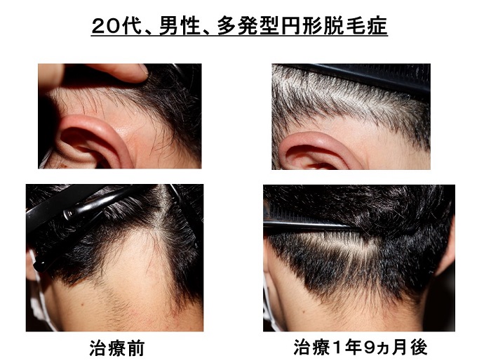 円形脱毛症　病院